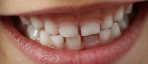 Wady zgryzu – jak im zapobiec?